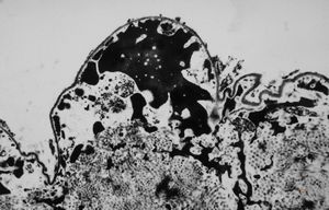 M, 63y. | cyst of choroid plexus - dystrophic calcification M, 63y. | cyst of choroid plexus - dystrophic calcification